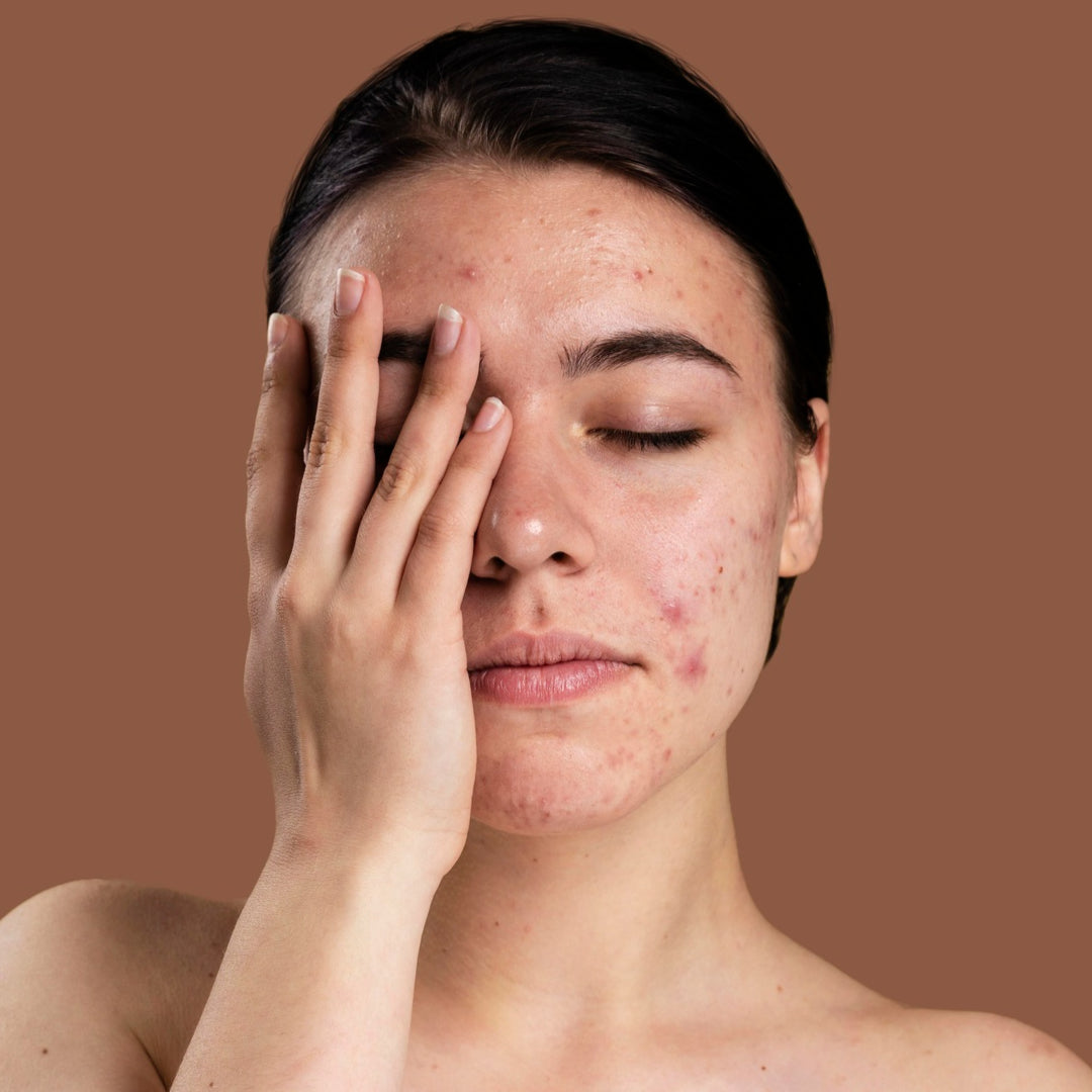 7 Rimedi Efficaci per Combattere l'Acne e Ottenere una Pelle Radiosa